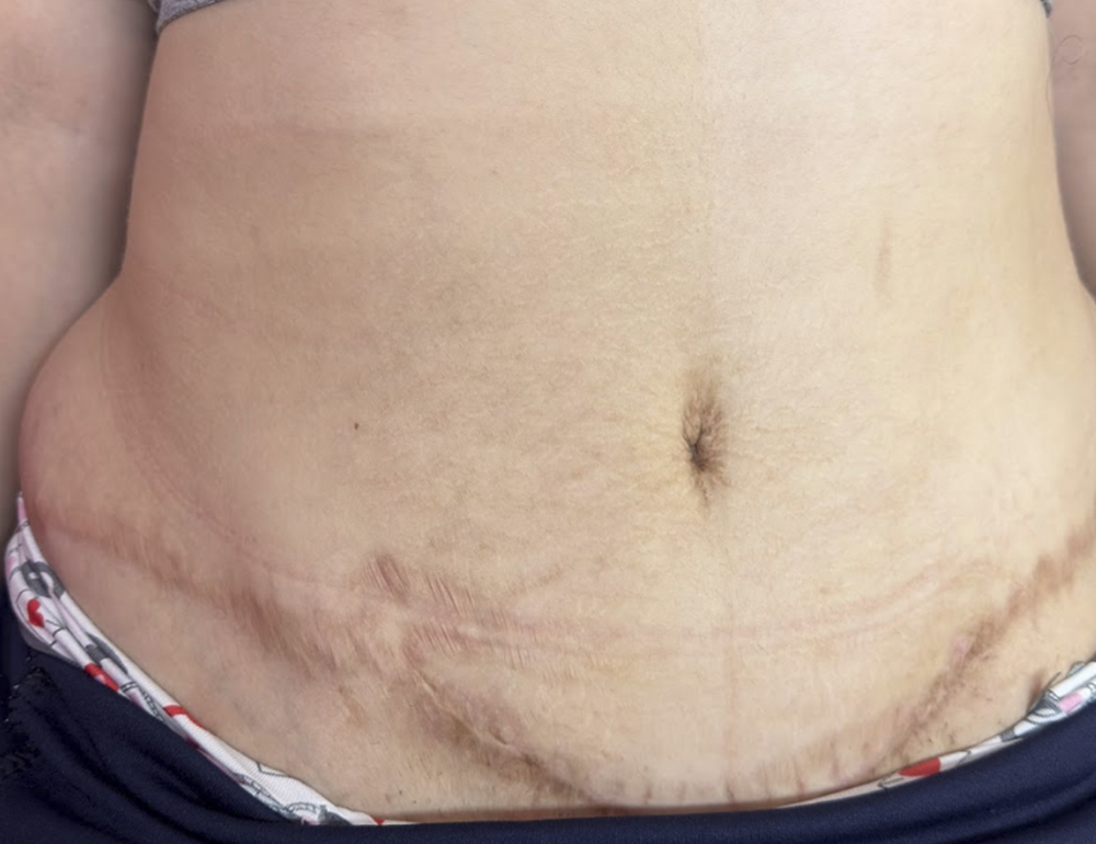 Depois do tratamento